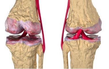 Krampfadern der Entwicklung der Gonarthrose