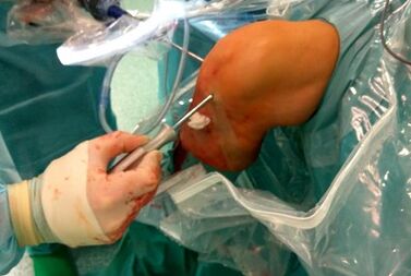 Chirurgische Intervention zur Arthrose