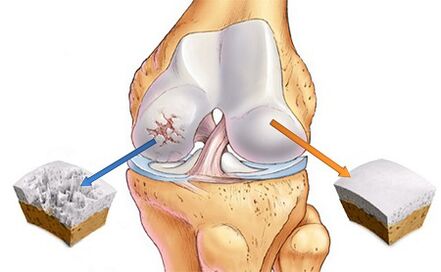 Was ist Arthrose des Kniegelenks